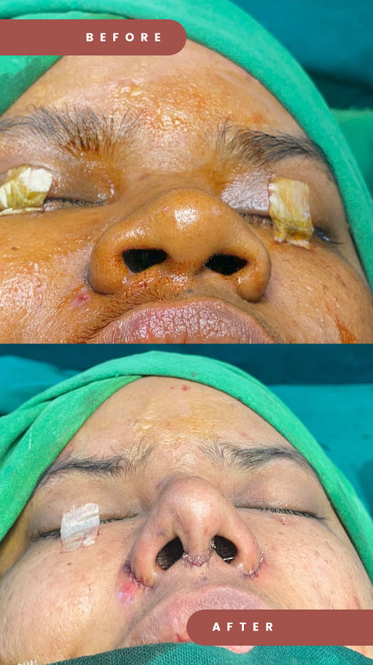 Rhinoplasty (Nose Job) – Procedure, Benefits, Recovery & Precautions