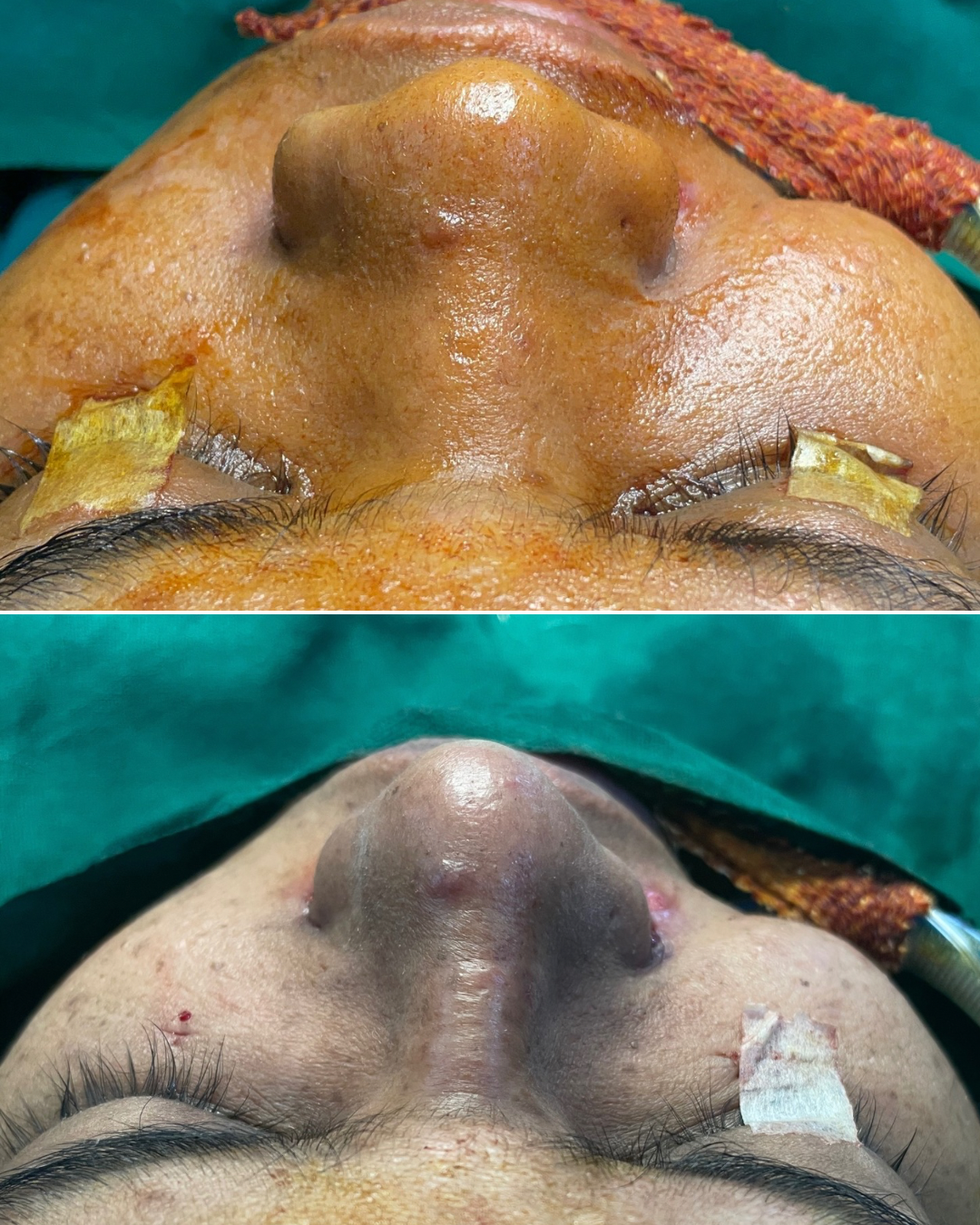 Rhinoplasty (Nose Job) – Procedure, Benefits, Recovery & Precautions